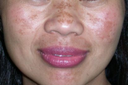 Melasma1