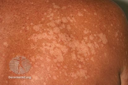 Tinea-Versicolor