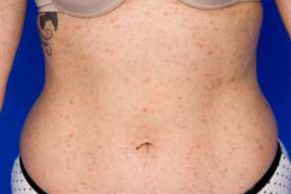 Pityriasis-Rosea1