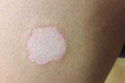 Pityriasis-Rosea2